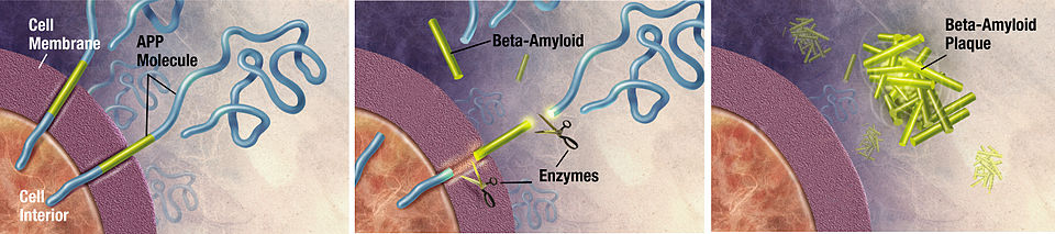 Amyloid plaque formation between neurons in Alzheimer's disease
